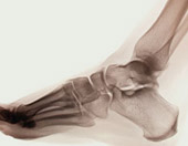 w-ray of bones in feet